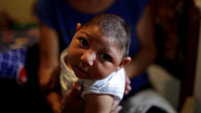 Symptoms Of Microcephaly Associated With Zika Cases